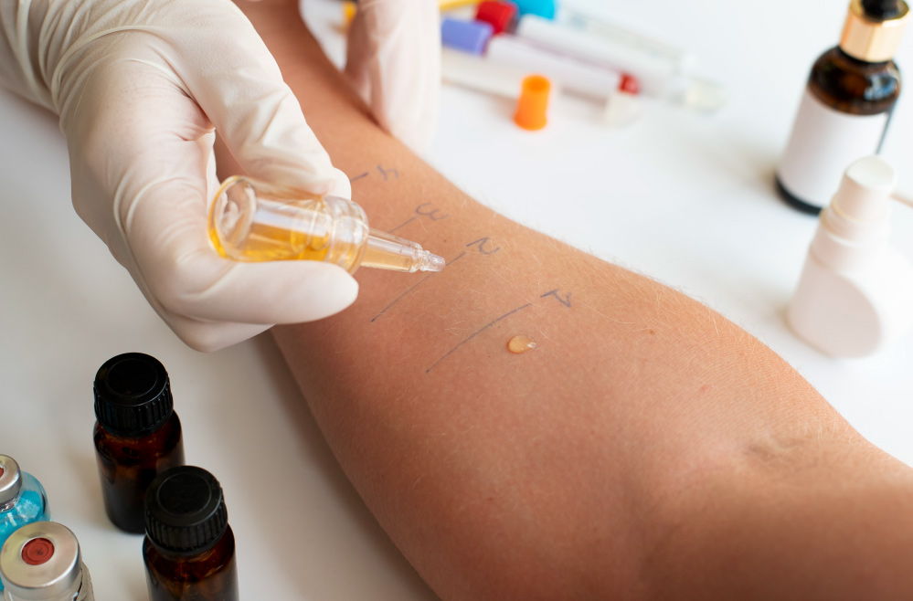 prick-test-alergia-alimentaria-barcelona